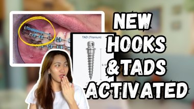 Braces Updates | TADS | Gaps | Braces Journey