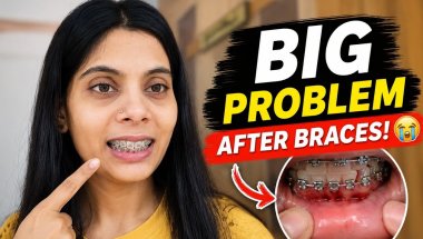 Finally Lower Braces Lag Gaye ❤️ But Something Went Wrong! | Braces Journey #7 #bracesjourney