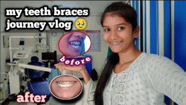 My teeth braces journey 🦷 1 year complete ho chuka hai !🥹