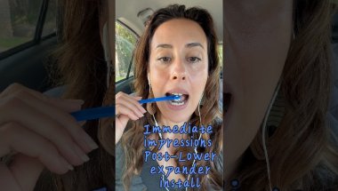 Pt 2 Impression day of install for adult LFE (lower fitting expander) #airway #orthodontics
