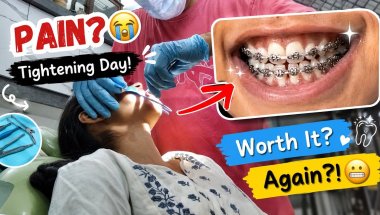 Getting My Braces Tightened Again! 😬 Honest Review