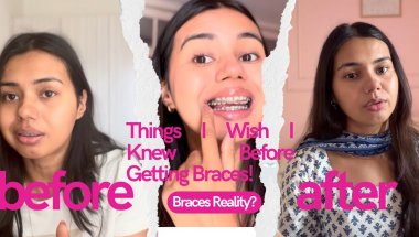 STOP! Watch This BEFORE You Get Braces 🛑