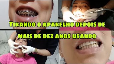 Tirei o Aparelho Ortodontico Depois de Mais de Dez Anos Usando