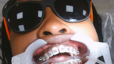 WATCH ME GET MY BRACES ON 😬🦷 | Slim Samone 😘