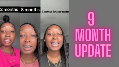 My 9 month braces journey