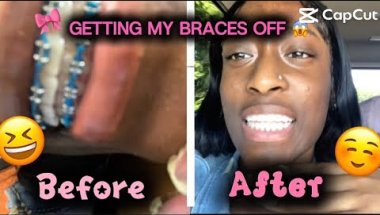 I FINALLY GOT MY BRACES OFF😱| After 4 years