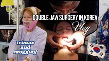i got double jaw surgery in korea... now i mog