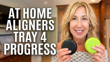 At home aligners (Smileie) tray 4 progress and thoughts, with a helpful tip from @TracyCampoli