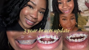 3 years braces update! Braces off soon! Open bite and over jet correction, extractions and more.