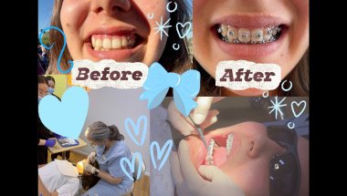 Braces and other shenanigans vlog