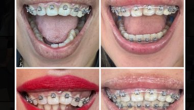 2 Years in Braces Update and Result