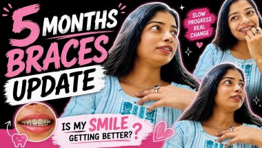 5 Months with Braces | Before vs Now | Honest Update✨