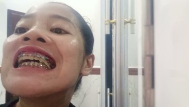 Getting Braces 😁 smile 😁