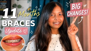 🦷 11 Month Braces Update | Progress, Pain & Results!