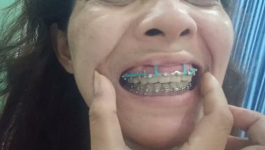 Orthodontics Braces 😁 smile 😁