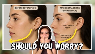 Do Braces Cause Sunken Face, Airway Problems & Sleep Apnea?