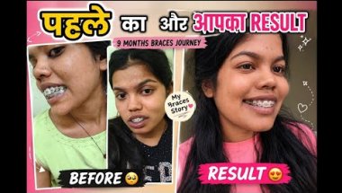 😱 9 Months Braces Journey | Before vs After Result 🦷 | 4 Teeth Extraction 😭 | My Honest Experience