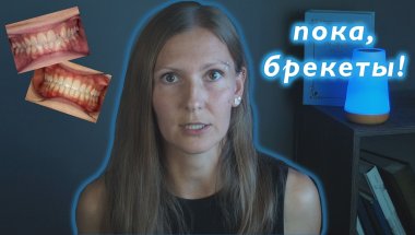 Снятие брекет-системы, результат, зубы до и после брекетов