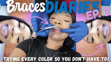 BRACES DIARIES EP.2 | I tried every color!