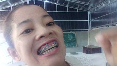 Good morning with getting Braces 😁 #teeth