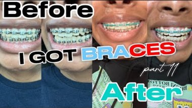 I GOT BRACES!! Part 11 | Powerchains, rubberbands, and bite blockers shaved down | Brya Life