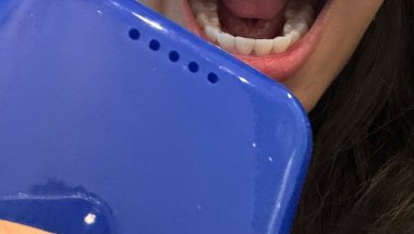 no more braces reveal