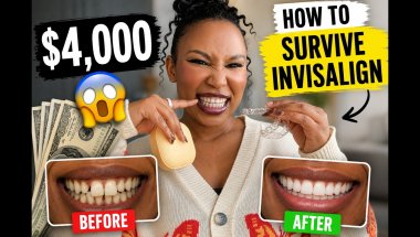 Things I wish I knew before getting clear aligners / Invisalign?