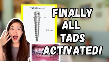 July Braces Updates | 2nd TAD Activation