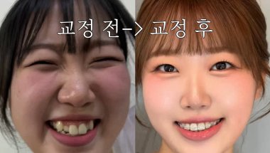 교정 1년차의 극현실 교정 브이로그(교정기 조인 날)