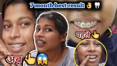 7th month best result 🦷😬#dentist #dentalcare #braces #bracesjourney #bracespain