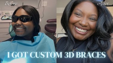 I got BRACES for the first time as an adult?! ♡ (vlog + braces experience)