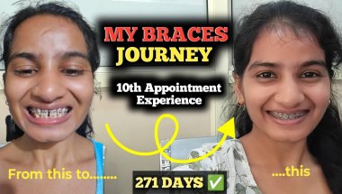 My Braces Journey: Closer to the Final Smile!🥲