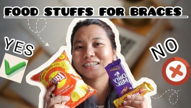 Braces treatment -What to eat/what to avoid...kya khaye aur kya nahi? #bracestreatment #trending