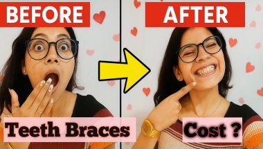"Braces की सच्चाई – दर्द, खर्चा और बदलाव | Full Journey in Hindi"