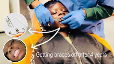 Getting braces off after 4 years #braces #bracesoff