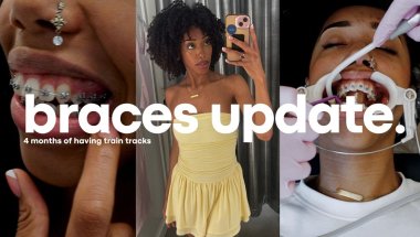 🥺 OMG THESE TRAIN TRACKS HURT | BRACES UPDATE