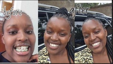 AFTER YEARS... My braces are finally off!😭🦷✨️