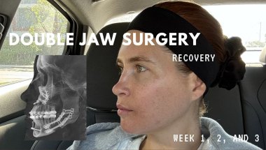 Double Jaw Surgery Recovery (week 1, 2, and 3)