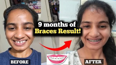 My Braces Journey: 9 months teeth transformation | face shape change?