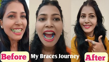 Braces journey || Braces/ Teeth Braces Before And After #braces #bracesjourney #bracestransformation