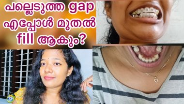 പല്ലെടുത്ത🦷 gap fill ആകാൻ എത്ര മാസം എടുത്തു ❓|Teeth braces |Malluz express