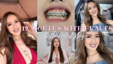Braces Vlog Ep.10: A YEAR OF HAVING BRACES ALREADY?! + teeth update ♡