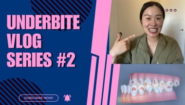 6 Month Invisalign Update, Cost, 3D Model | Underbite Vlog Series