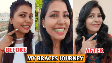 Braces Journey | Braces Before And After #braces #bracesjourney #adultbraces #trending