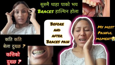 Braces Pain Experience 😖 | Before & After Braces Pain | Braces Journey नेपाली #braces #bracesjourney