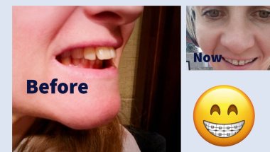 Decrease of overbite 😁 #braces #dentalbraces #teeth #overbite