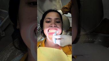 Braces installation (first-time)