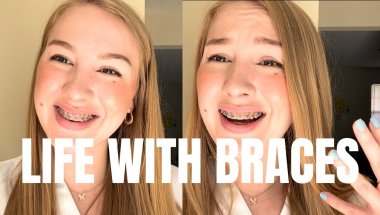 Braces Update: Are They Actually Worth It?