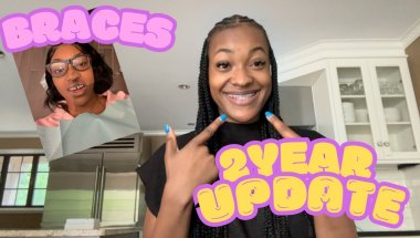 POV: Two years with Braces -Update