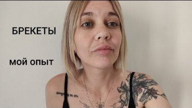 поставила БРЕКЕТЫ / мой опыт